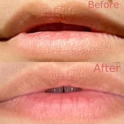 Patchology Rose Lip Gels - Pack of Five